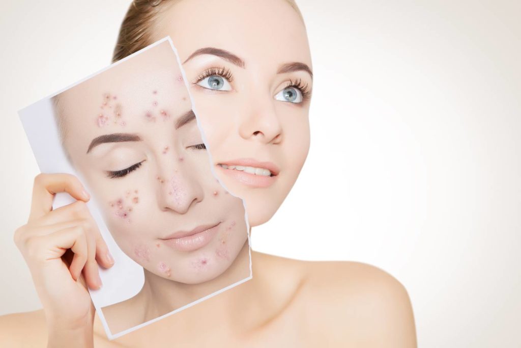 A women showing old picture with acne | Walnut Creek Aesthetics in Walnut Creek, CA