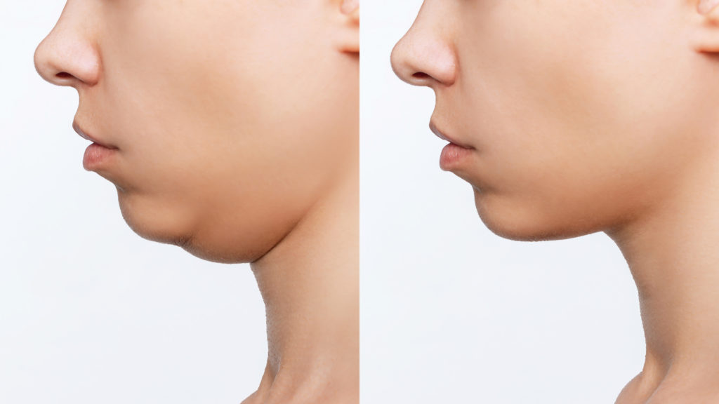 After and before double chin result | Walnut Creek Aesthetics in Walnut Creek, CA