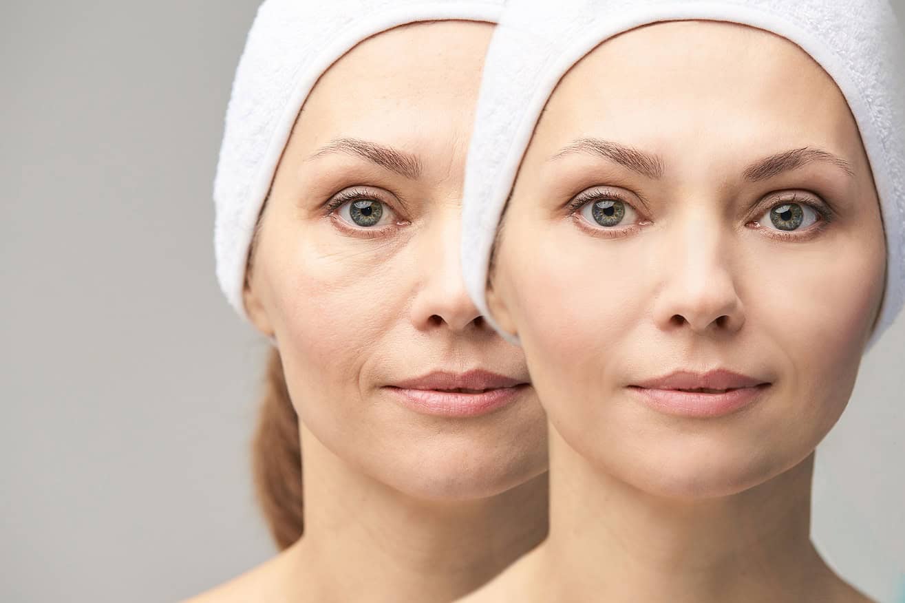 Pretty mature girl Before and after Image Anti wrinkle healthy therapy | Walnut Creek Aesthetics in Walnut Creek, CA