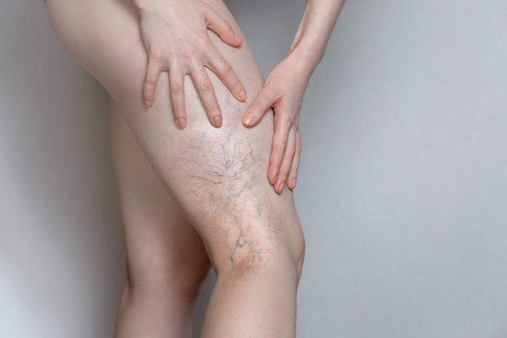 Woman shows leg with varicose veins | Walnut Creek Aesthetics in Walnut Creek, CA