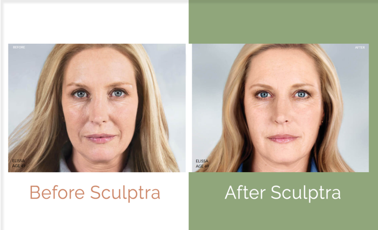 Sculptra Before and After Treatment | Walnut Creek Aesthetics in Walnut Creek, CA