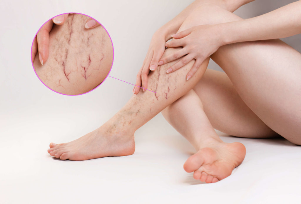 Spider Veins Treatments in Walnut Creek, CA | Walnut Creek Aesthetics