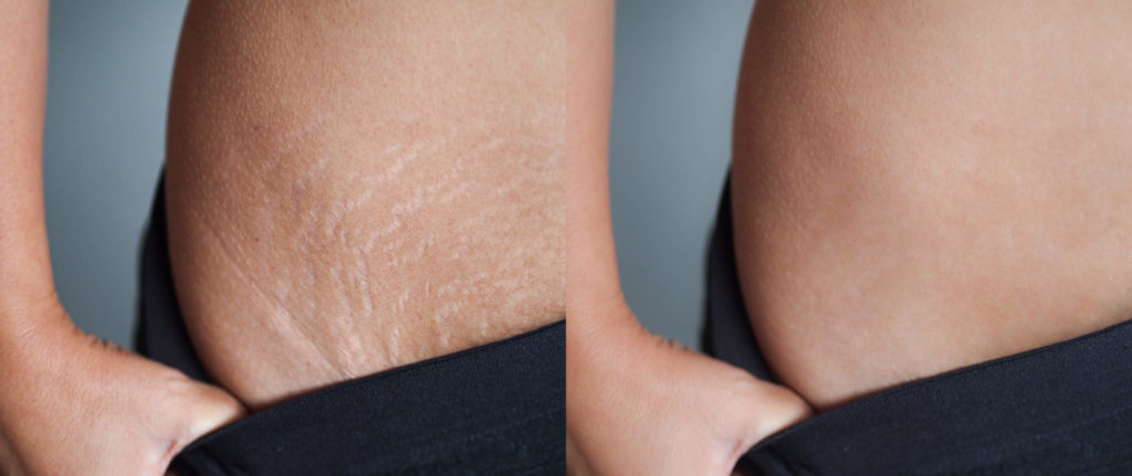 Stretch Marks Treatments in Walnut Creek, CA | Walnut Creek Aesthetics