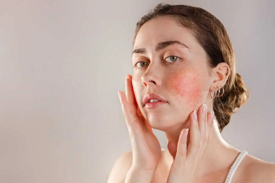 Rosacea by Walnut Creek Aesthetics DBA in Walnut Creek, CA.