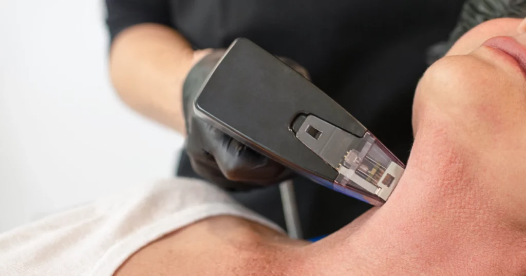 Morpheus8 treatment being performed on a patient's neck in Walnut Creek, CA
