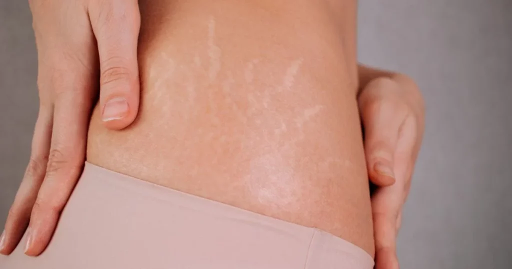 Close-up of stretch marks caused by weight changes at Walnut Creek Aesthetics