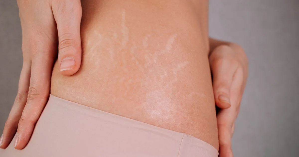 Close-up of stretch marks caused by weight changes at Walnut Creek Aesthetics