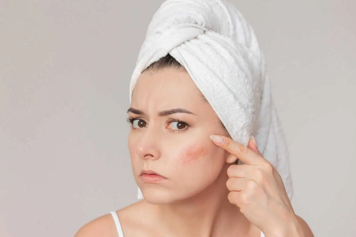 woman examining facial redness caused by rosacea while following skincare routine